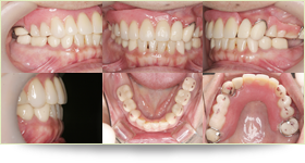 入れ歯の症例2 術中