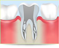 保険内での根管治療