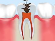 1.歯根の露出
