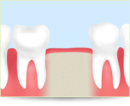 歯の抜けた部分は放置しないでください