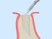 歯茎の切開