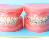 STEP②　矯正装置で歯を移動させる「成人矯正」