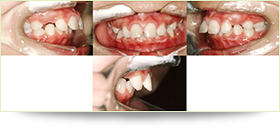 小児のケース　Class2　上顎前突（出っ歯）②