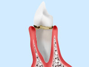 状態 軽度歯周病