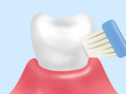 治療法1 軽度歯周病