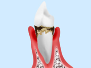 状態 中等度歯周病