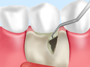 治療法2 中等度歯周病