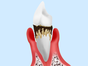 状態 重度歯周病 