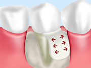治療法1 重度歯周病 