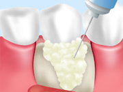 治療法2 重度歯周病 