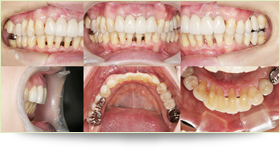 オールセラミックと矯正をしたケース