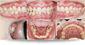 オールセラミックと矯正をしたケース