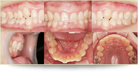 オールセラミックと矯正をしたケース